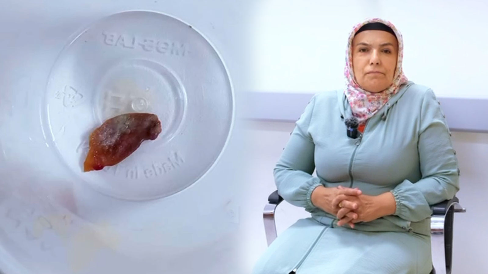 1 buçuk senedir geçmeyen öksürüğünün nedenini öğrenince hayatının şokunu yaşadı: Akciğerine yapışmış! 1 buçuk senedir geçmeyen öksürüğünün nedenini öğrenince hayatının şokunu yaşadı: Akciğerine yapışmış!