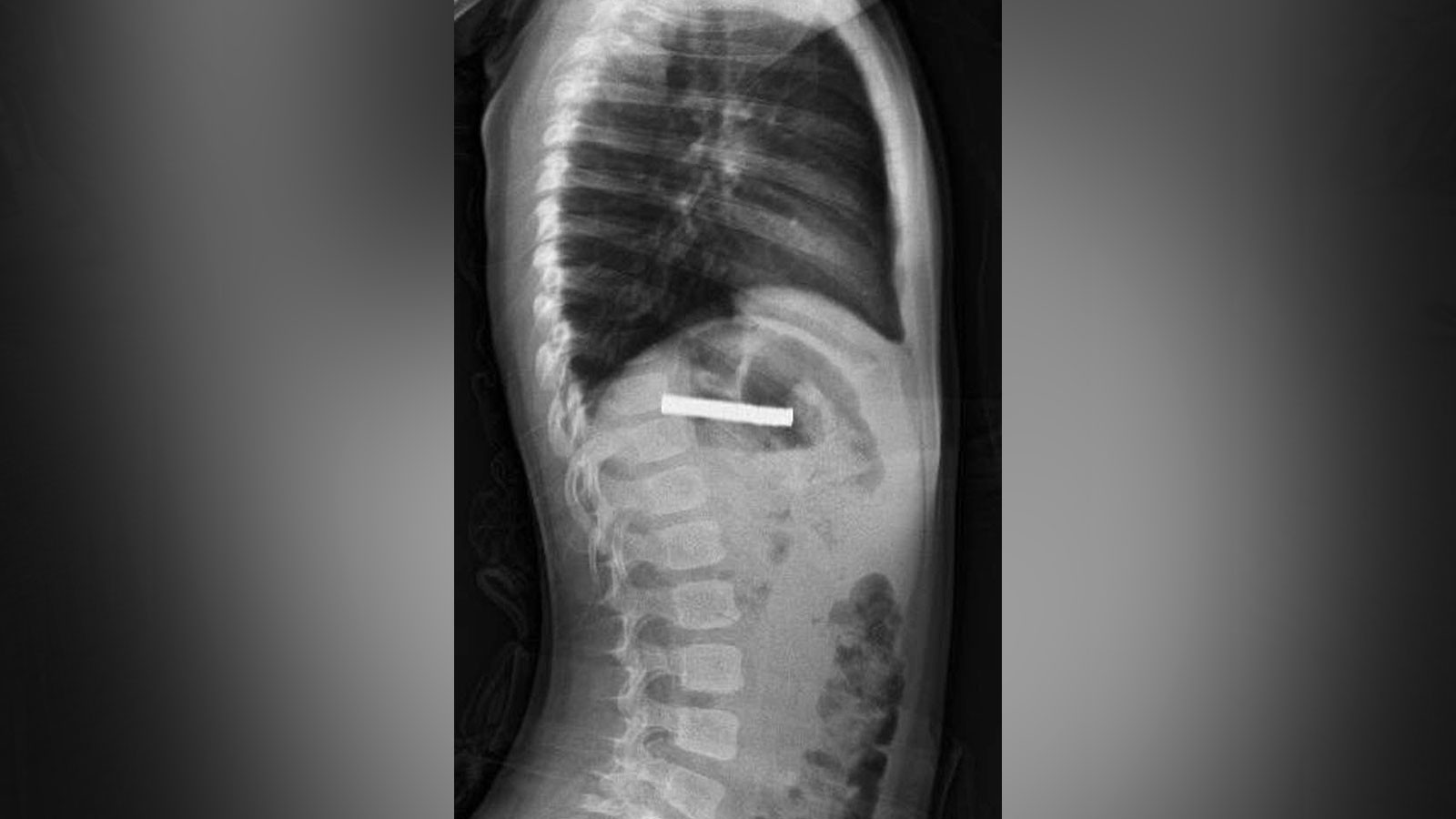 Hepsi, 3 yaşındaki çocuğun yemek borusundan çıkarıldı: Tam 19 adet!